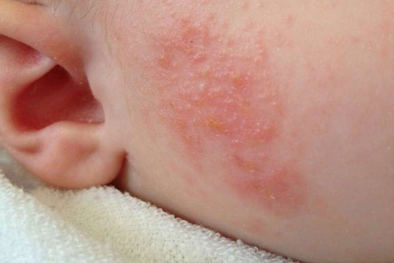 dermatite atopica neonato